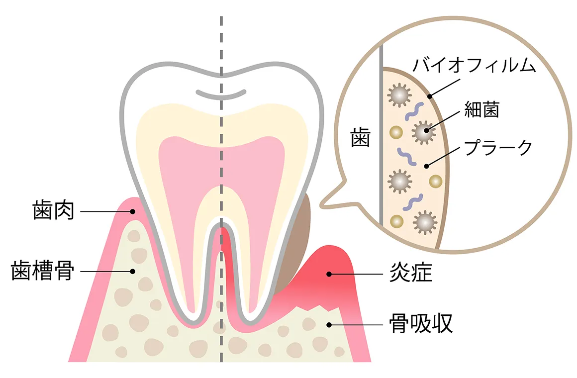 なぜ、毎日の歯磨きだけでは不十分なのでしょうか？