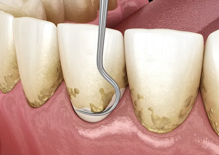 スケーリング（歯石除去）