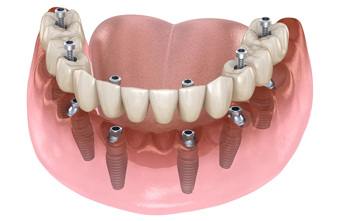 オールオンファイブ（All on 5）、オールオンシックス（All on 6）