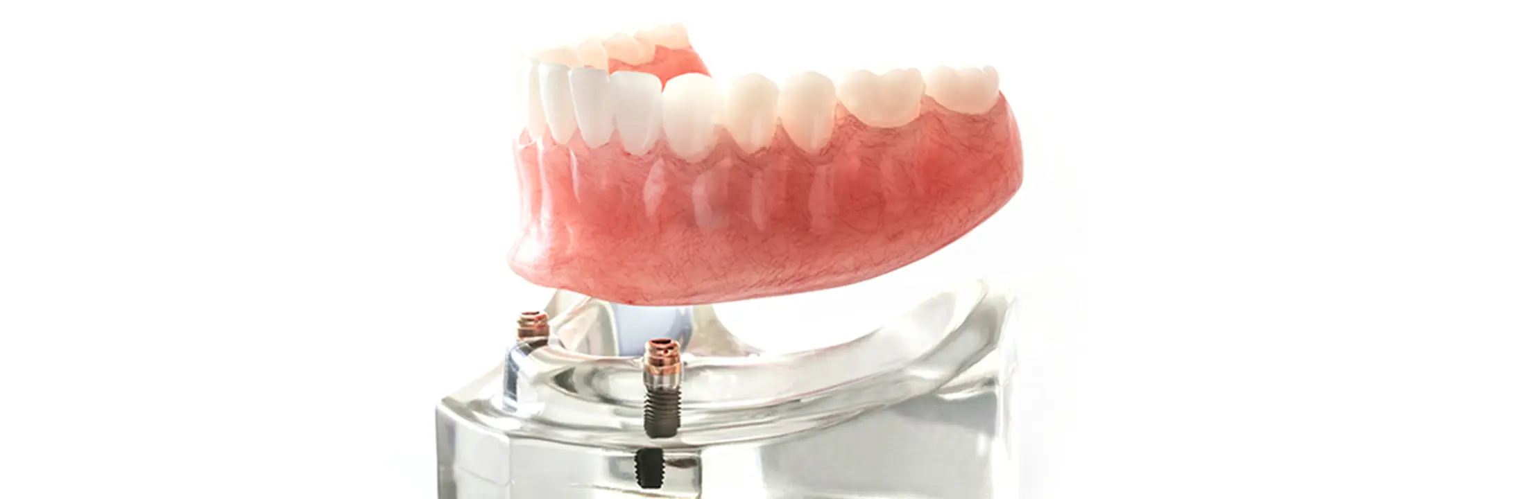 インプラントオーバーデンチャー