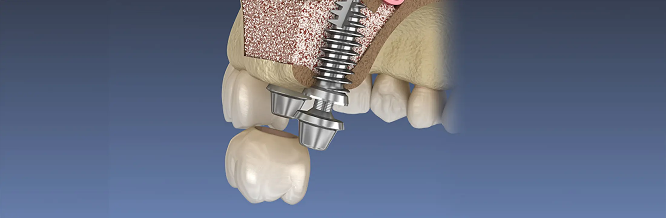 骨が足りない方のインプラント治療