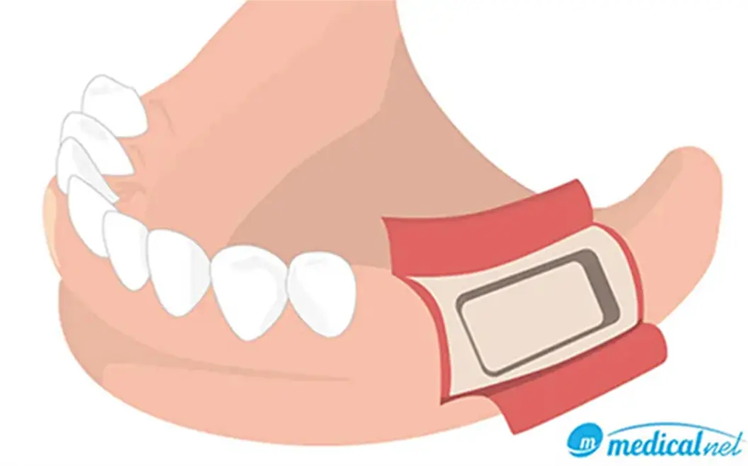 GBR（骨誘導再生法）