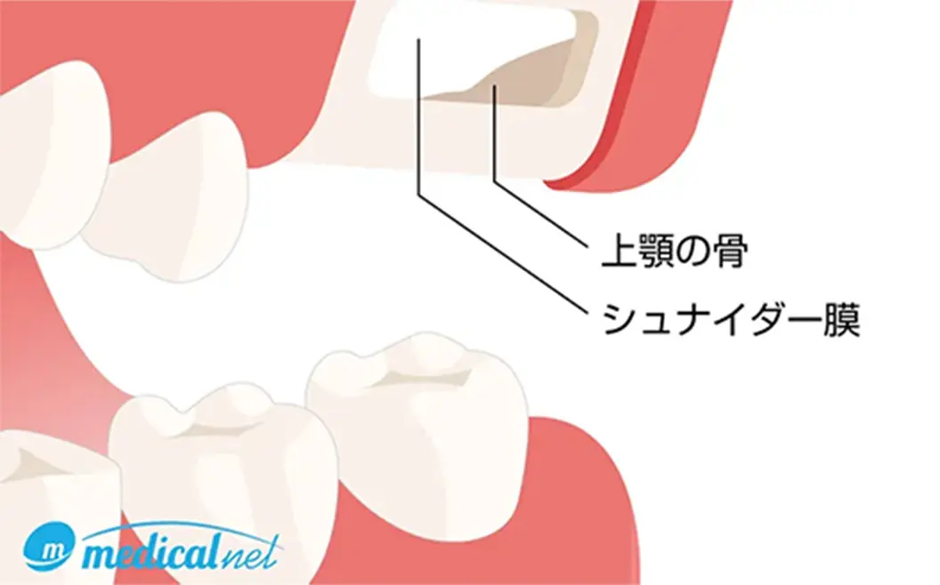 サイナスリフト（上顎洞底拳上術）