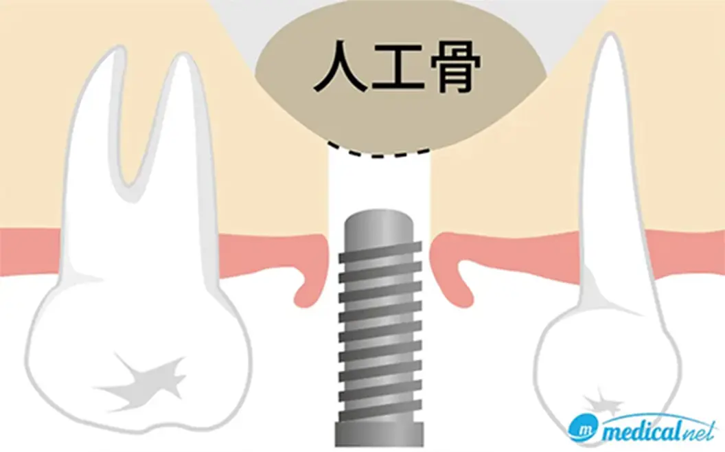 ソケットリフト（上顎洞底拳上術）