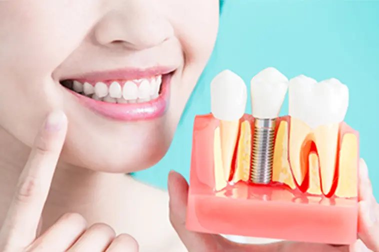 最終ブリッジの装着