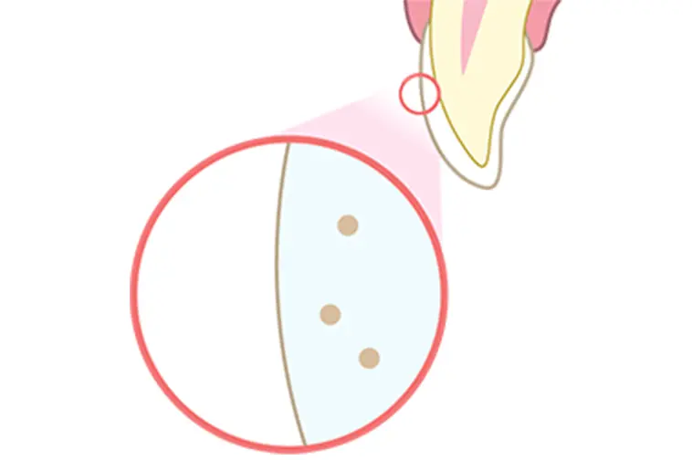 歯が白く美しく変化